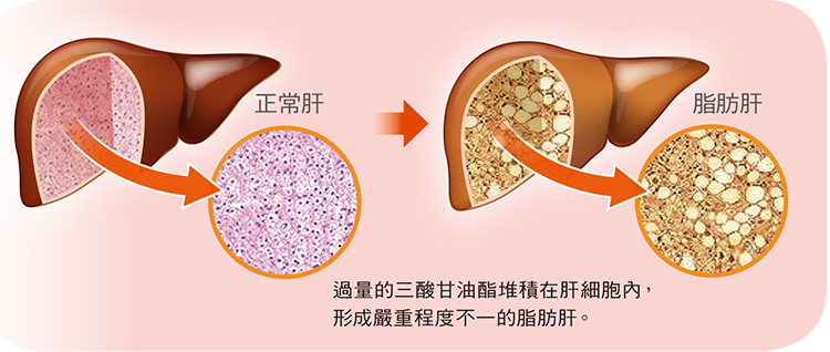 「脂肪肝!」非酒精性脂肪性肝炎