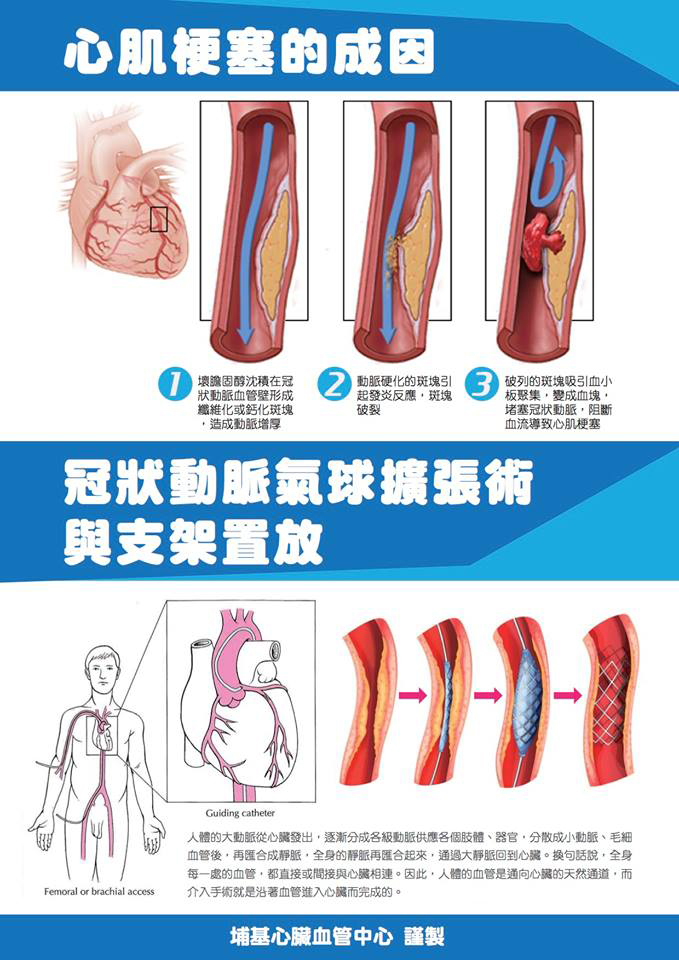 血管阻塞？氣球擴張術 配合置放支架